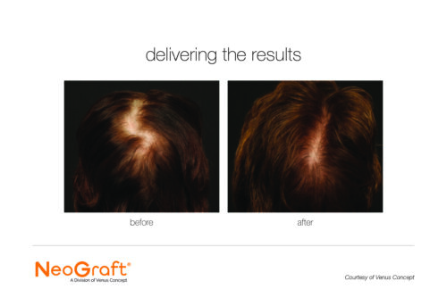 NeoGraft Results3