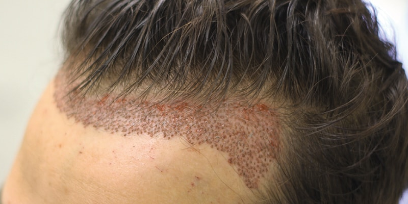 FUE hair transplant – Neo Graf