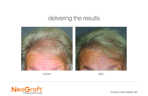 neograft-results3