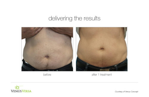 VenusVersa_B&A_HairRemoval_VenusConcept_1Tx