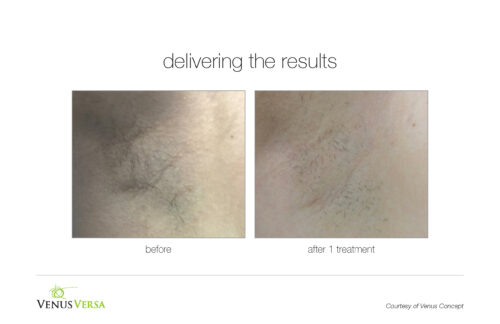VenusVersa_B&A_HairRemoval_VenusConcept_1Tx_2