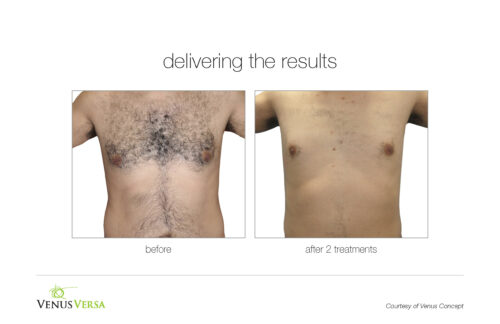 VenusVersa_B&A_HairRemoval_VenusConcept_2Tx
