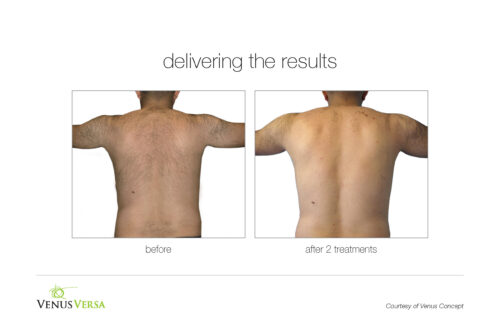 VenusVersa_B&A_HairRemoval_VenusConcept_2Tx_2