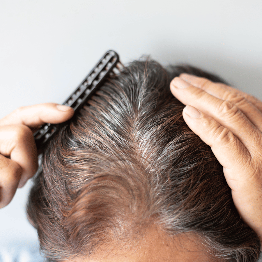 NeoGraft Hair Restoration